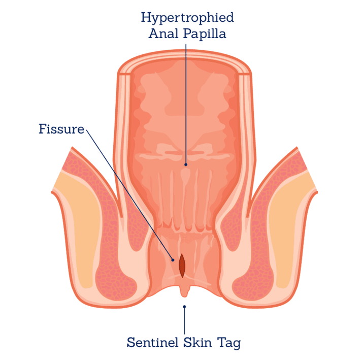 फिसर (Fissure)