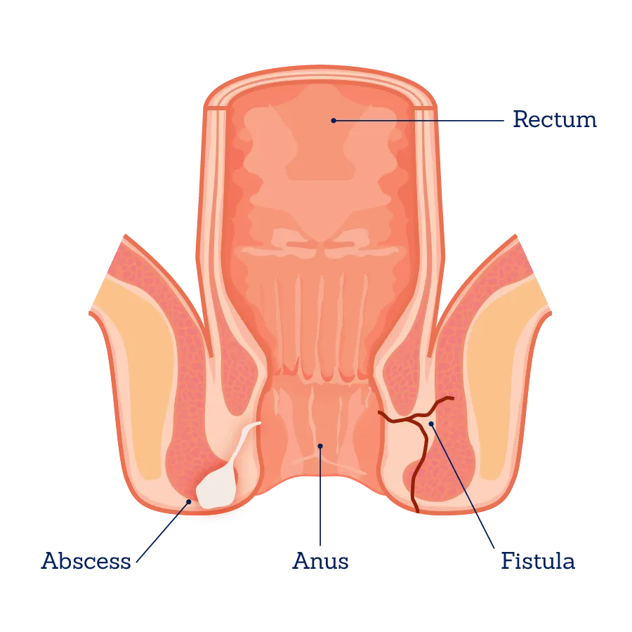 फिस्टुला (Fistula)